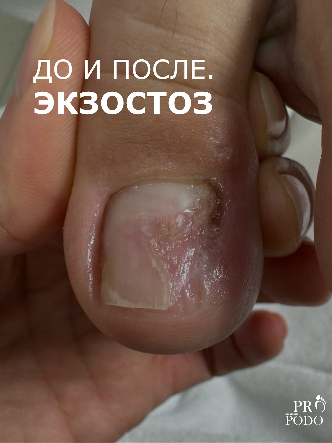 Экзостоз
