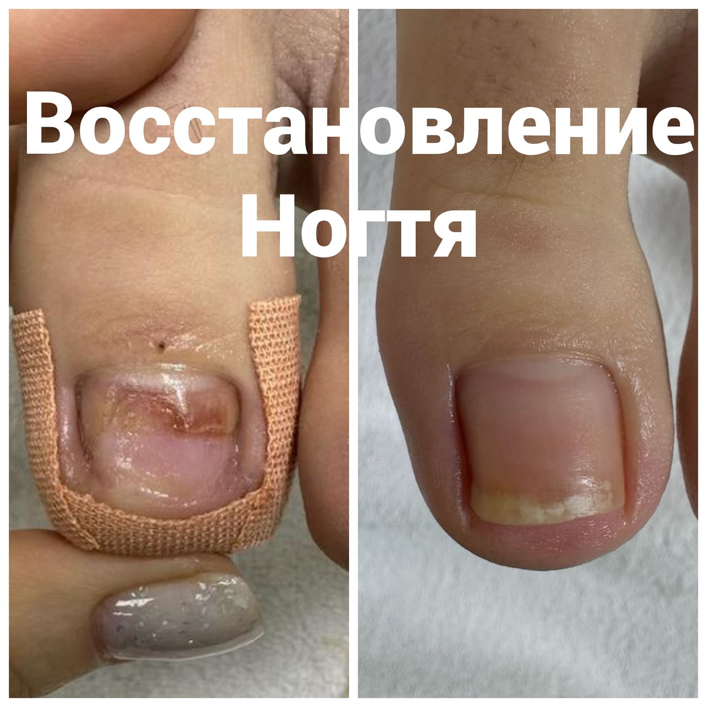 Восстановление ногтя